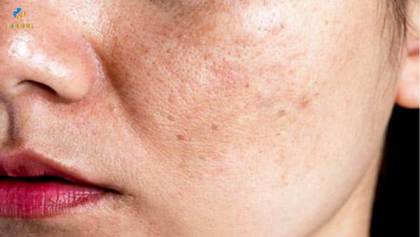 Cách trị nám tàn nhang tại nhà hiệu quả bằng nha đam