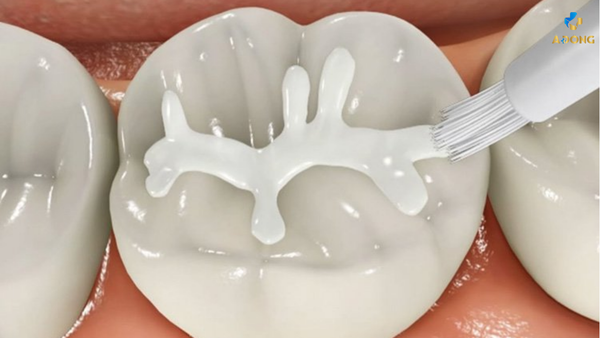 Trám sealant – Giải pháp chống sâu răng cho trẻ tại Á Đông