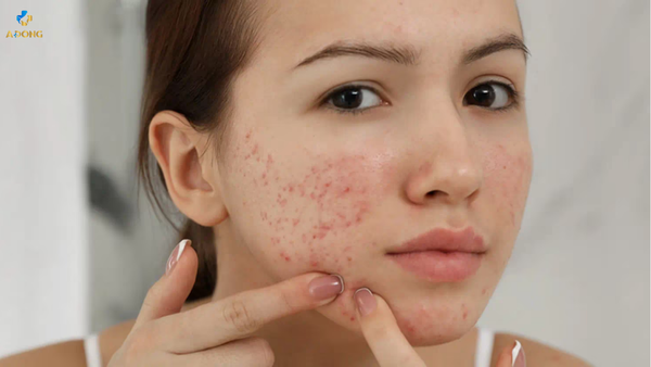 Cách trị mụn hiệu quả tại nhà cho mặt, lưng và thâm mụn