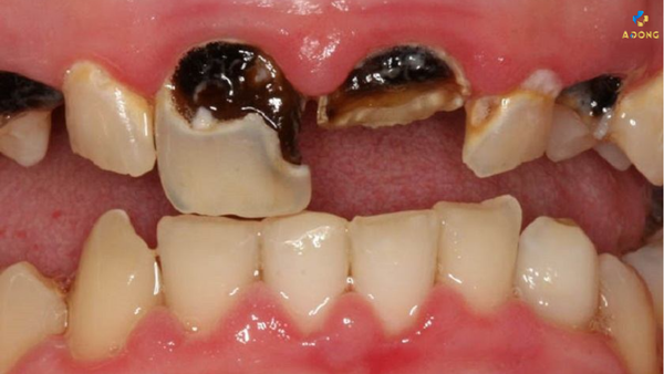 Trị sâu răng tại nhà: Những mẹo nhỏ nhưng hiệu quả