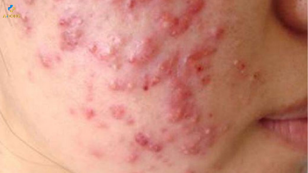 Bí quyết trị mụn trứng cá tuổi dậy thì hiệu quả và an toàn